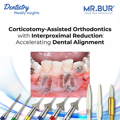 Corticotomy-Assisted Orthodontics with Interproximal Reduction accelerates dental alignment using advanced tools like Mr. Bur One Slice IPR Kit.