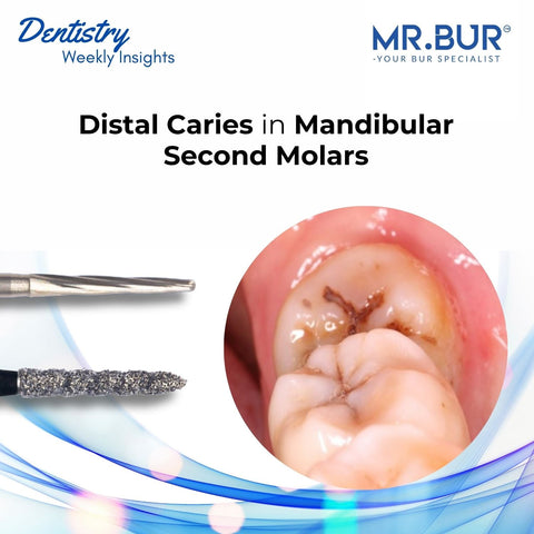 Mr. Bur highlights distal caries in mandibular second molars commonly associated with impacted third molars and plaque accumulation on the distal surface.