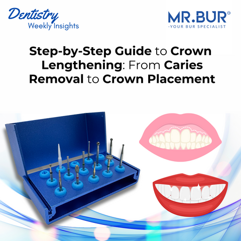 Step-by-step crown lengthening using Mr. Bur Surgical Crown Lengthening Kit FG for caries removal, soft tissue trimming, bone reduction, and crown preparation.