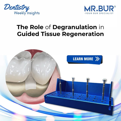 Cover image highlighting the role of Mr. Bur Degranulation Kit in achieving precision and success in Guided Tissue Regeneration procedures.