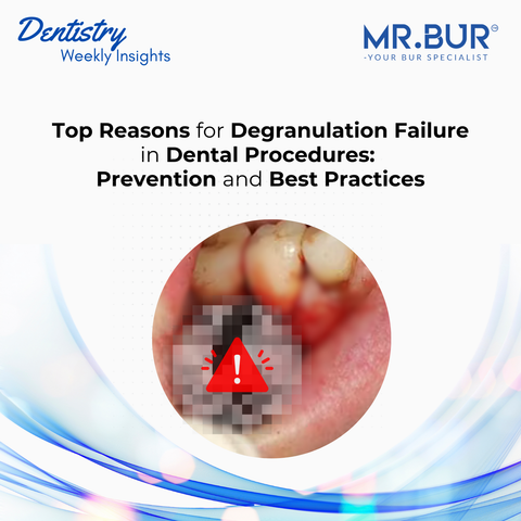 Mr. Bur blog article titled 'Top Reasons for Degranulation Failure in Dental Procedures: Prevention and Best Practices' offering expert insights on tissue removal techniques and success strategies in dentistry.